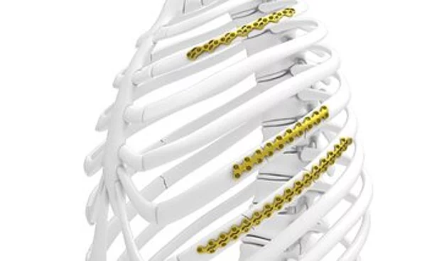 Thorax-Fixationssystem L1® Rib Thorax-Fixationssystem L1® Rib